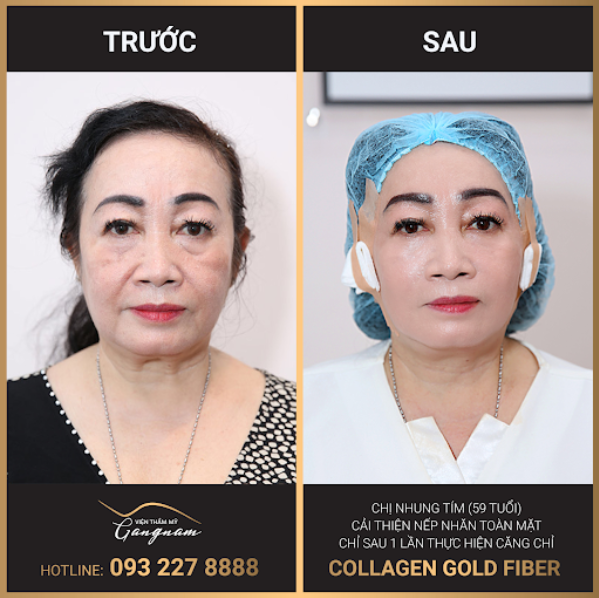 Khách hàng cô Thu (62 tuổi) thực hiện ca căng chỉ toàn mặt với Collagen Gold Fiber