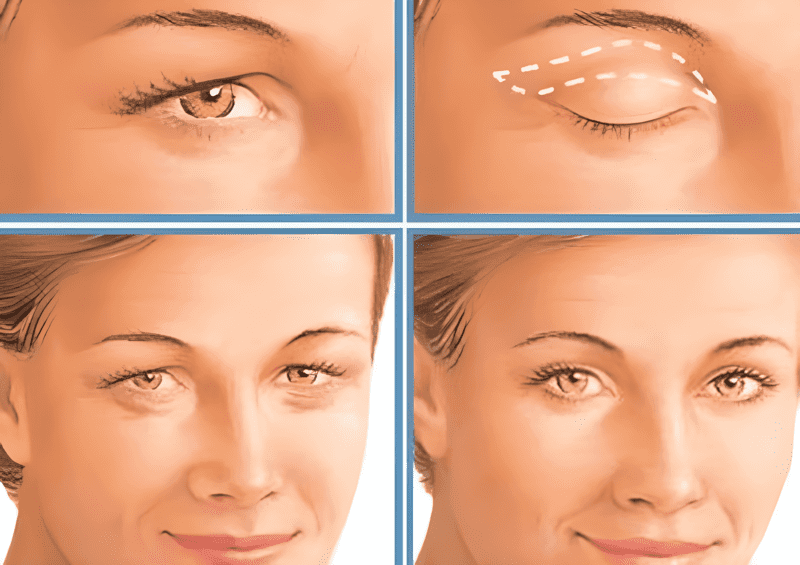Lão hóa hay các tác động bên ngoài khiến vùng mắt chùng nhão đều có thể thực hiện tiểu phẫu cắt bỏ