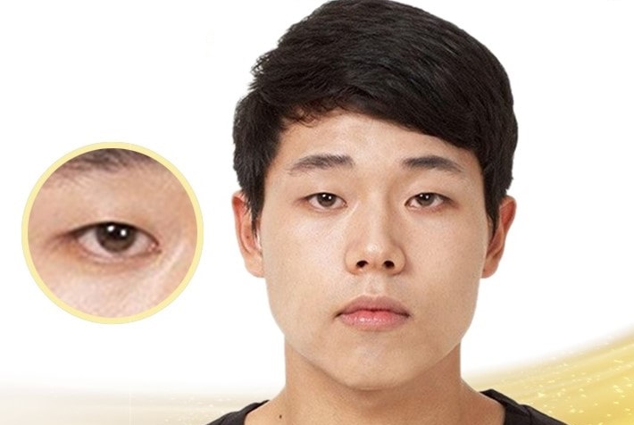 Cắt mí mắt cho nam giới giúp đôi mắt to tròn, trẻ trung hơn 